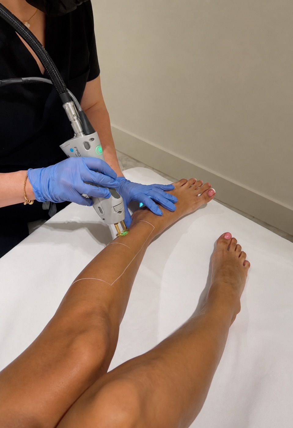 Laser hair removal on the legs with the Candela GentleMax Pro at Daniéle